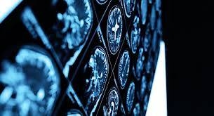 美国科学家发现新冠病毒能直接进入脑组织　