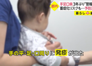 日本手足口病患者激增