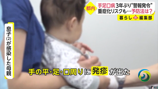 日本手足口病患者激增