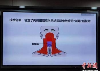 中国团队创新放疗“减毒”技术  预计使99%鼻咽癌患者受益