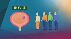 清除衰老细胞或可成为治疗膀胱癌新方法